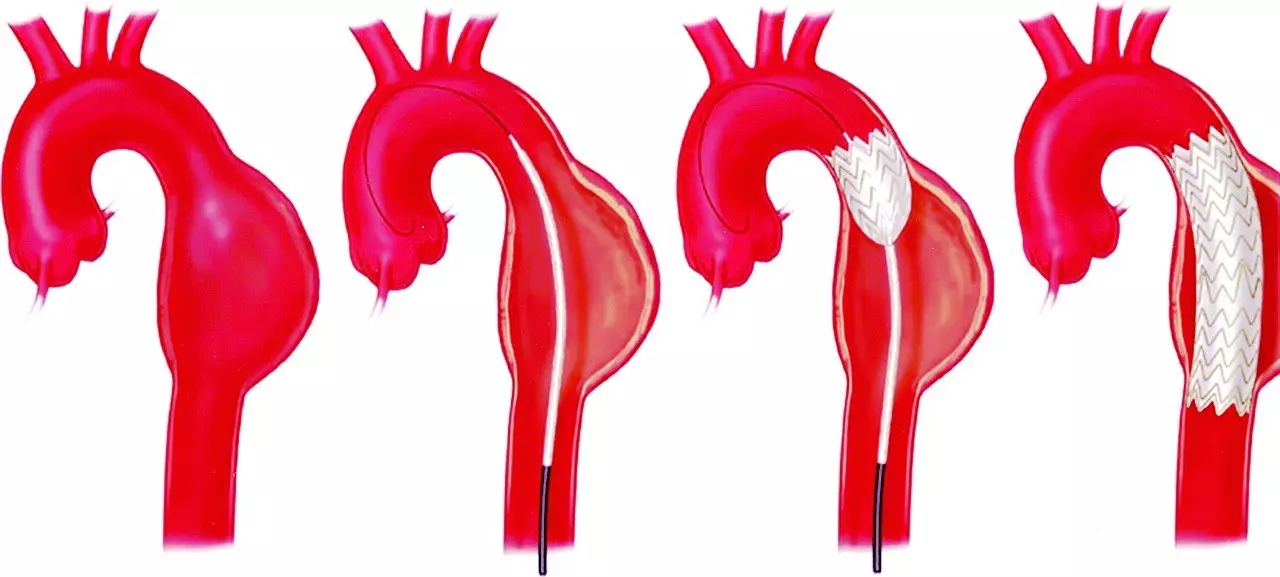 Phình động mạch chủ ngực: căn bệnh nguy hiểm không nên chủ quan